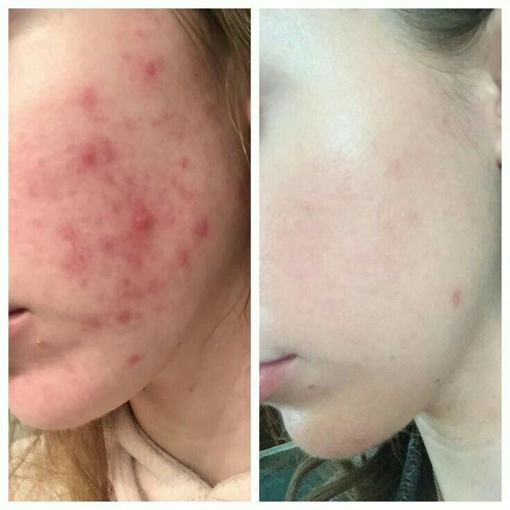 Gel acné KORMESIC 10% Benzoyl Peroxide de Danoir Paris dans un flacon de 30ml, texture transparente avec étiquette.