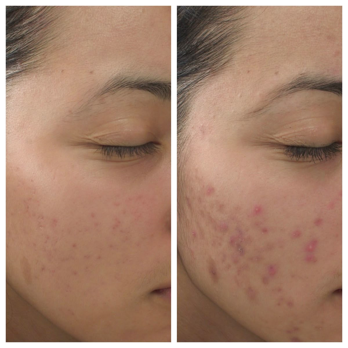 Gel acne intensif au peroxyde de benzoyle KORMESIC 10% de Danoir Paris, flacon de 30 ml, pour traiter l'acné.